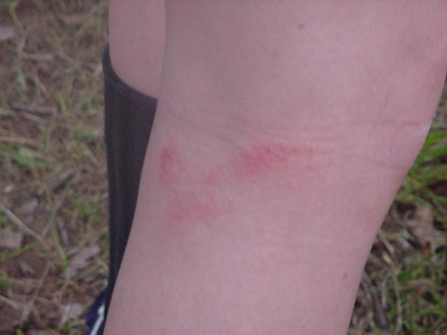 Rope burn on Gretchen's leg.jpg